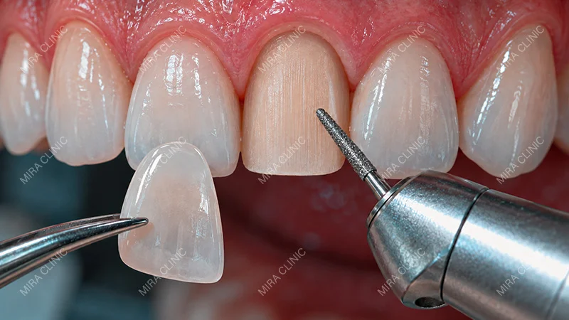When Is Deep Tooth Preparation Necessary for Veneers
